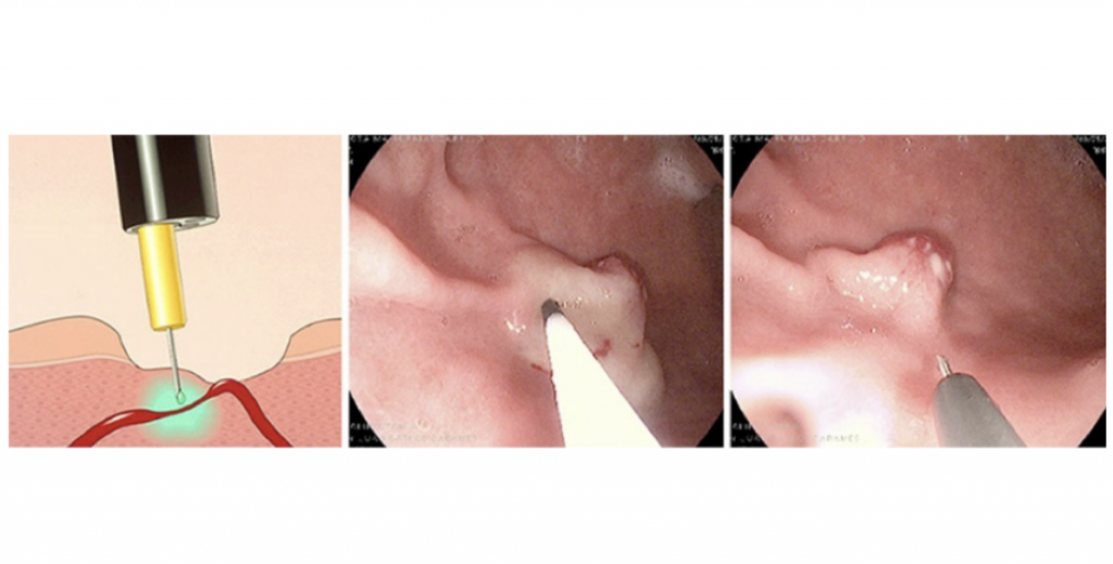 CONTROL ENDOSCOPICO DE HEMORRAGIA GASTRICA MEDIANTE ESCLEROTERAPIA