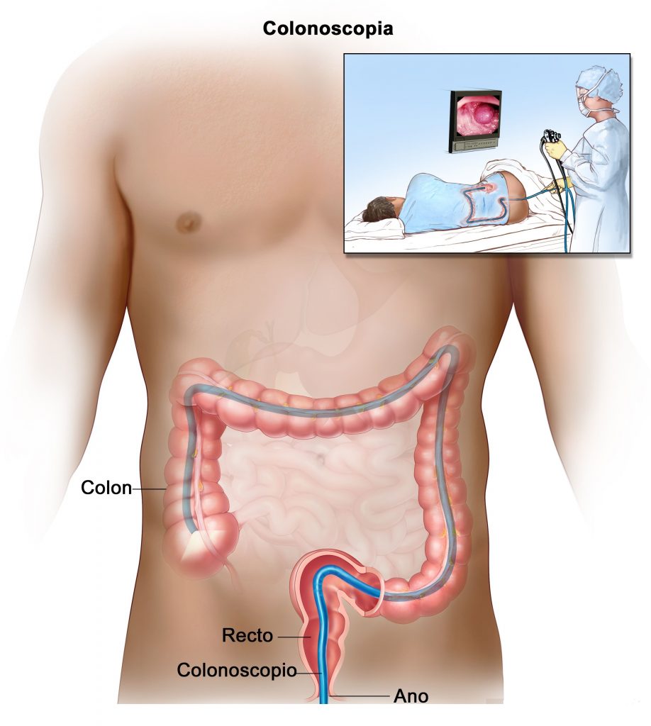 Coloroscopia ¿QUÉ ES LA COLONOSCOPIA? - Incide S.A.S. Calidad en Gastroenterología